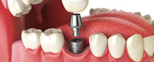 Dental implants in Astoria, NY